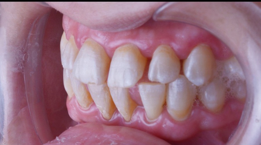 قبل تركيبات-اسنان